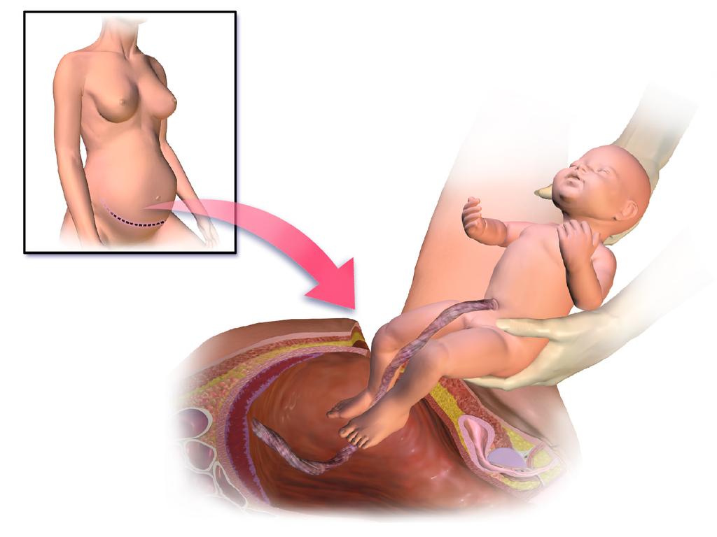 Persalinan operasi sesar ( C-section)